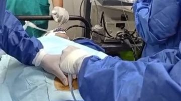 ابتكار جديد في علاج الجلطات بدون جراحة بمستشفى حميات منوف
